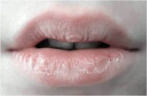 Close up of cracked lips. 