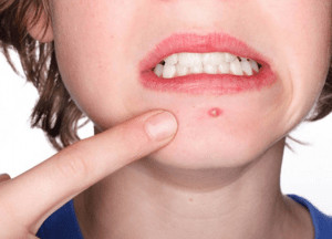 Close up of teenagers face with zit. 